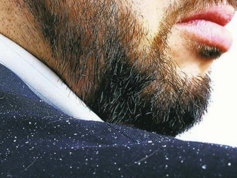 Beard Dandruff Causes Prevention And Treatment Urbane Man 